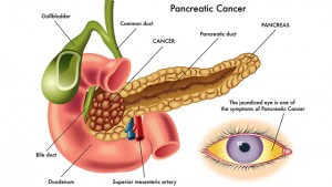 PancreaticCancer-1